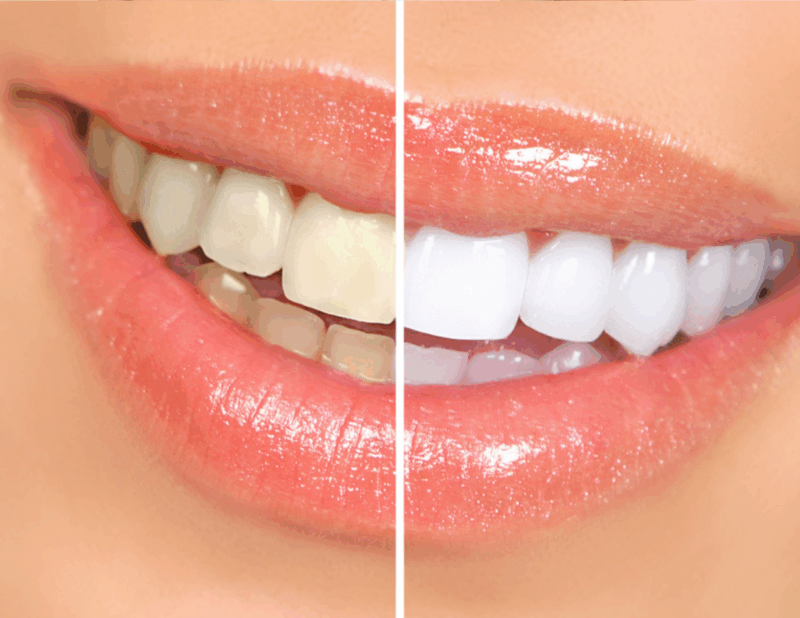 teeth-whitening