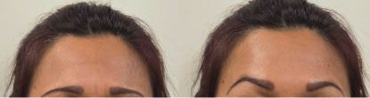 eleven-lines-forehead-lines-after