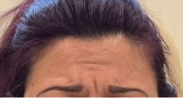 eleven-lines-forehead-lines-before