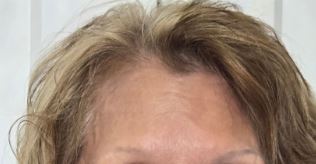 forehead-lines-wrinkles-after