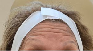 forehead-lines-wrinkles-before
