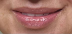 lip-flip1-after