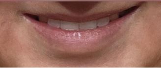 lip-flip1-before