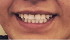 lip-flip2-after