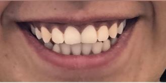 lip-flip2-before