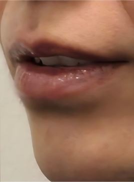 lip-flip3-after