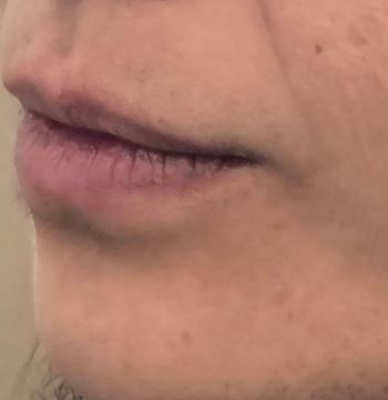 lip-flip3-before