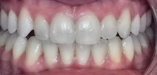teeth-whitening1-after