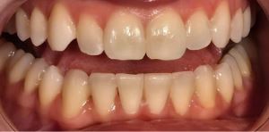 teeth-whitening1-before