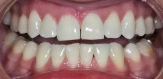 teeth-whitening2-after