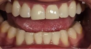 teeth-whitening2-before