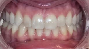 teeth-whitening3-after