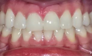 teeth-whitening4-after