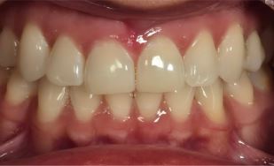 teeth-whitening4-before